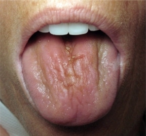 Sjögren’s Disease